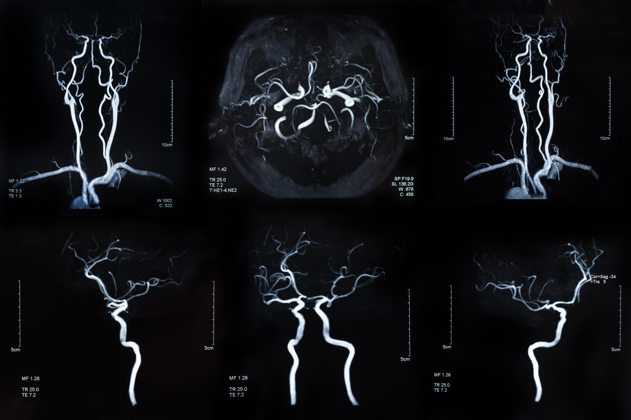 Immagine del risultato dell'angiografia cerebrale