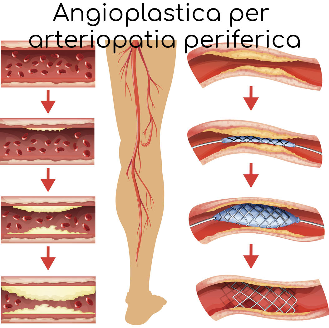 Angioplastica per arteriopatia periferica