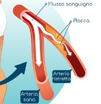 Esemplificazione della procedura di angioplastica per arteriopatia periferica