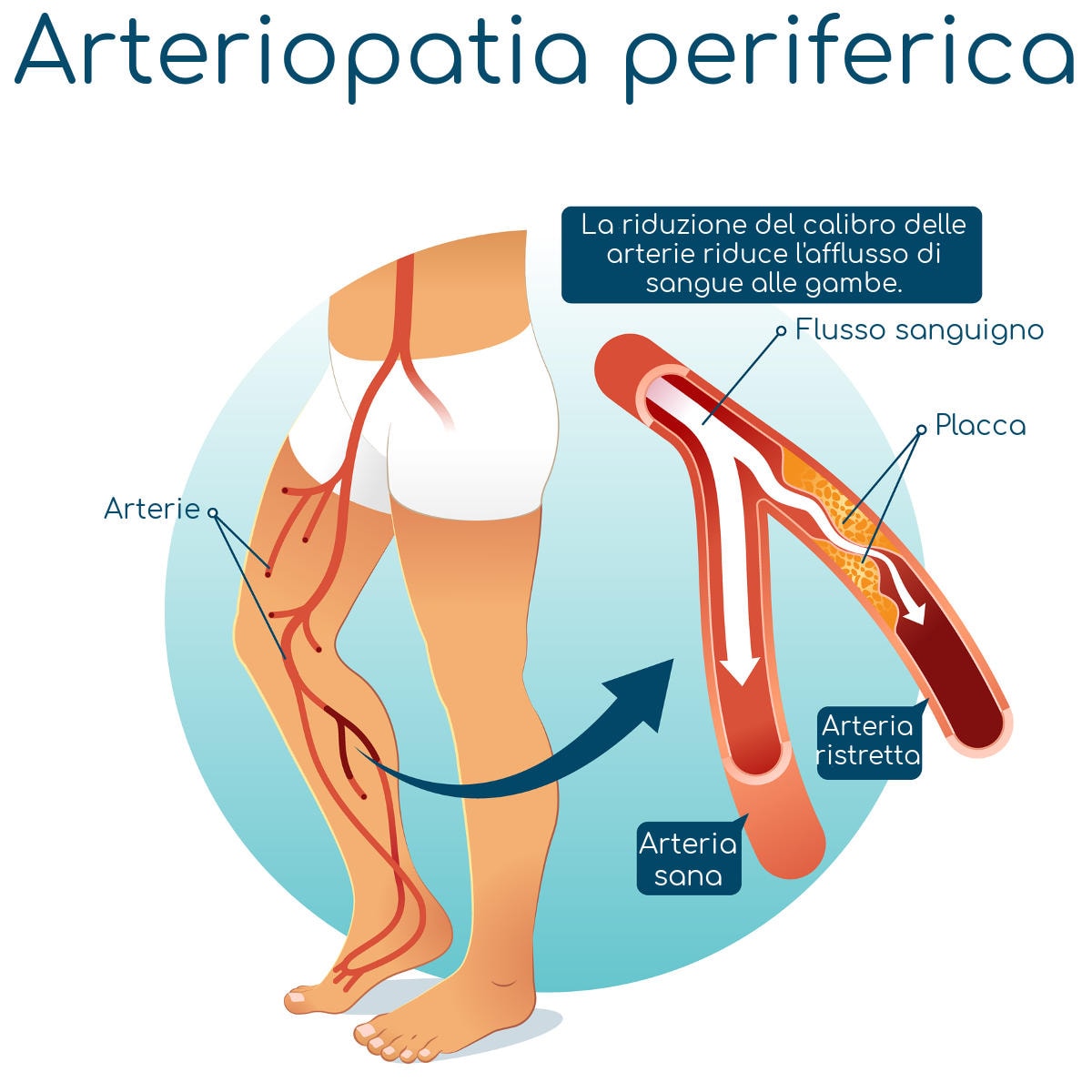 Esemplificazione delle cause che portano alla PAD attraverso l'aterosclerosi