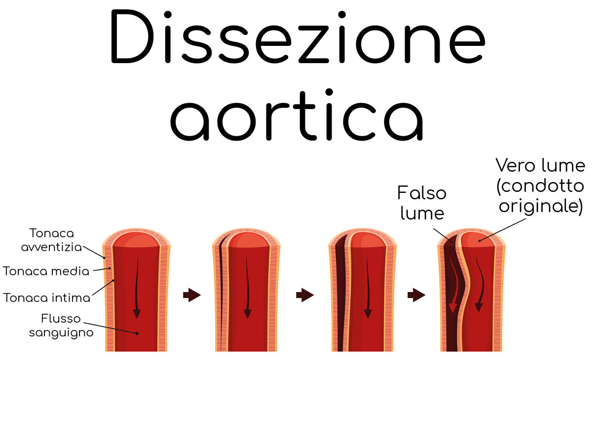 Esemplificazione della dissezione aortica