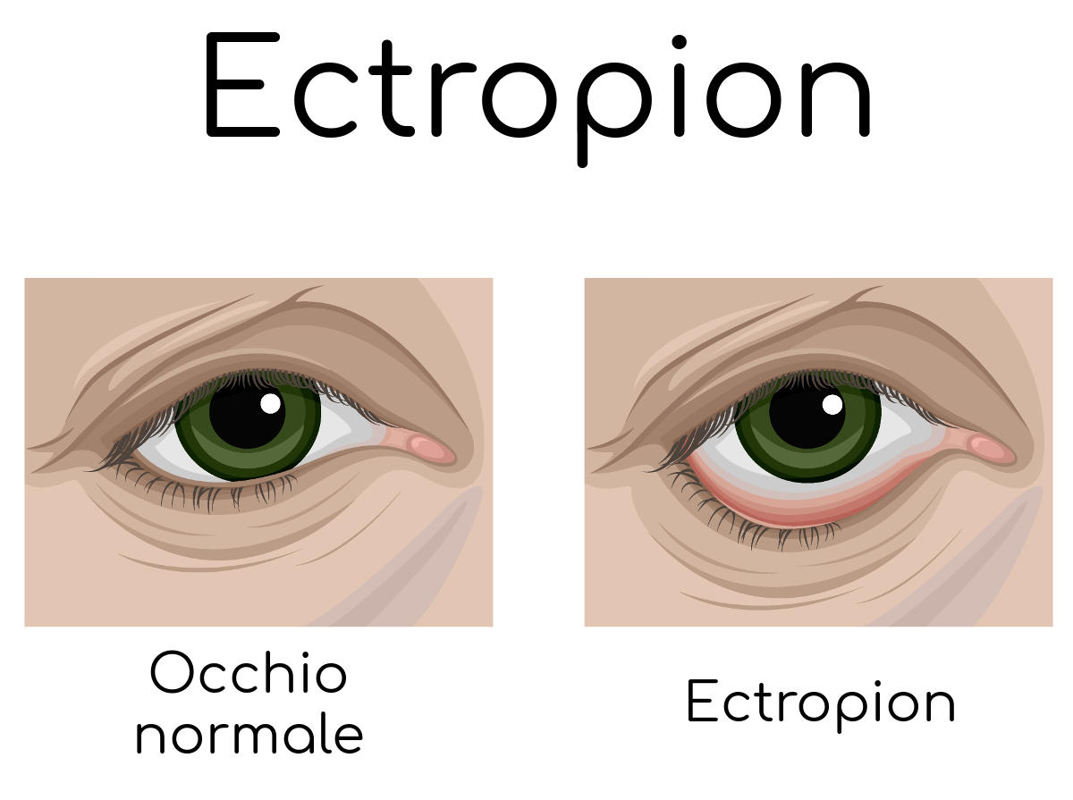 Paragone occhio sano ed ectropion