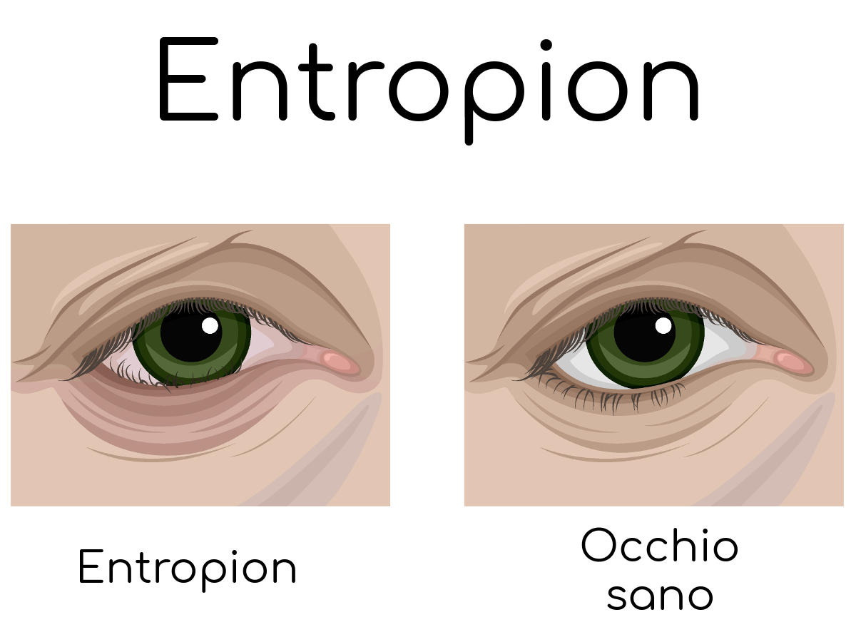 Entropion della palpebra inferiore