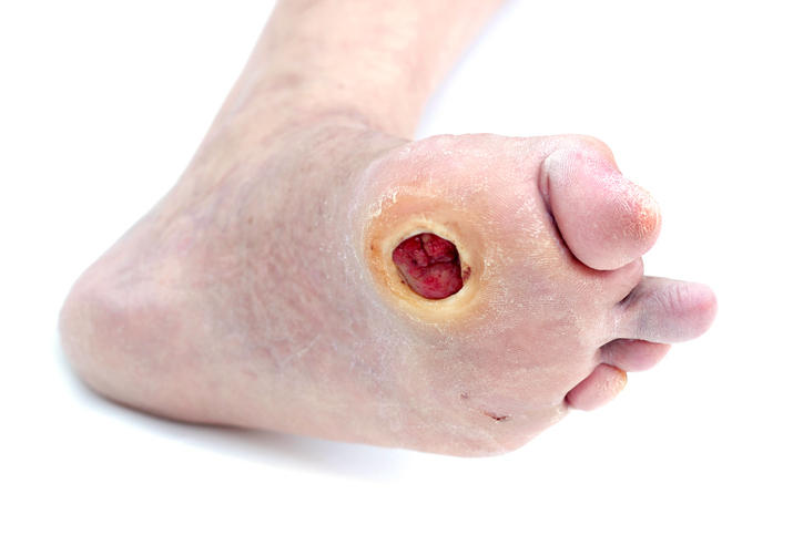 Ferita che non si chiude sulla pianta di un piede diabetico