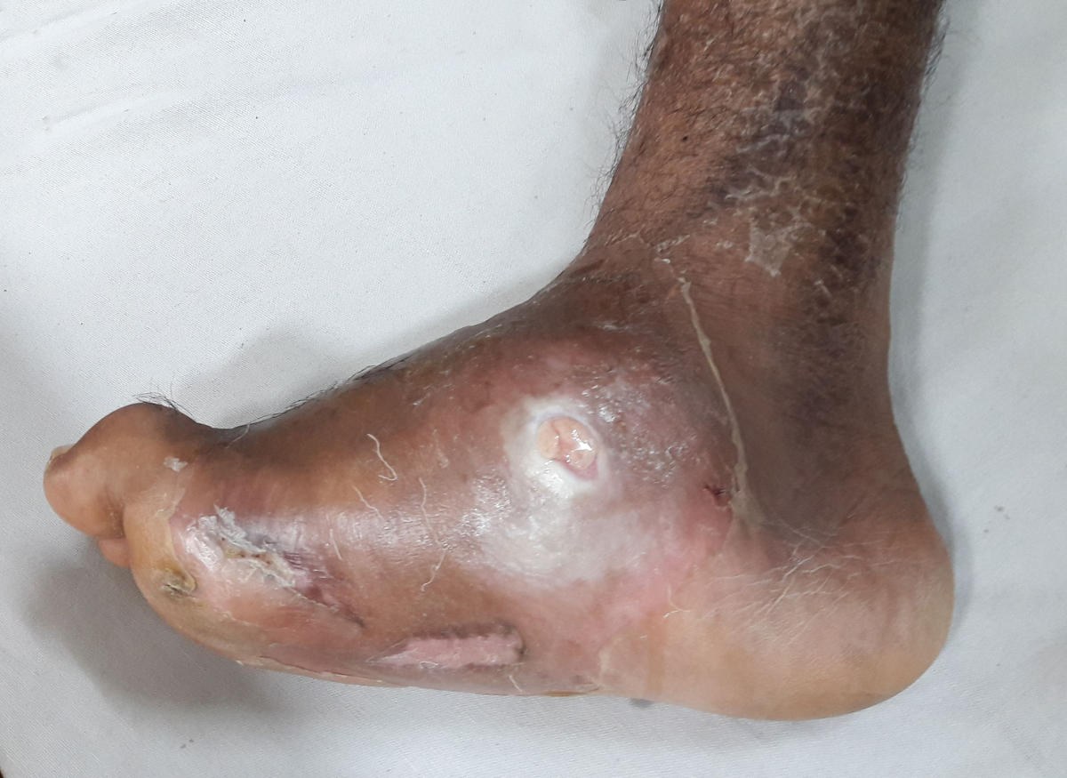 Deformit&agrave; del piede causata dai danni neurologici indotti dal diabete