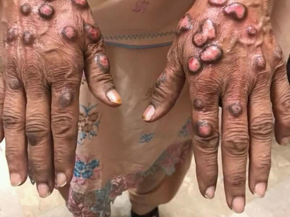 Prurigo nodulare sulle mani