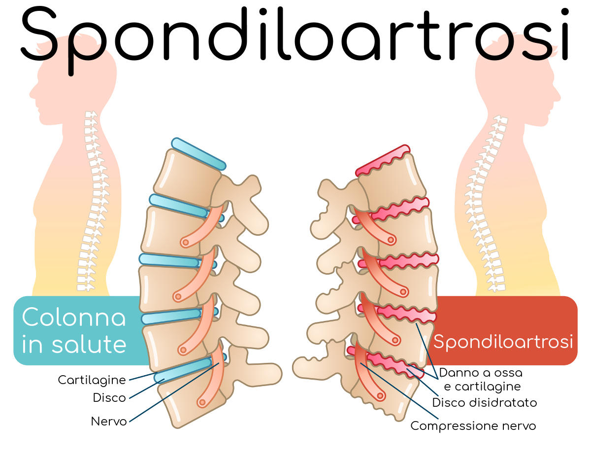 Paragone tra colonna vertebrale sana e affetta da artrosi