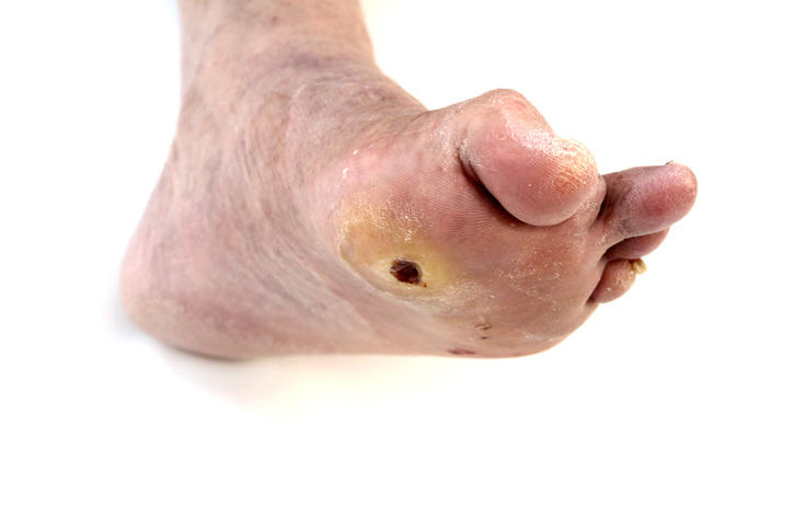 Ulcera sulla piante di un piede di un paziente diabetico