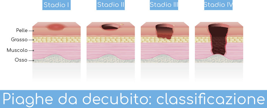 Rappresentazione grafica delle lesioni da pressione