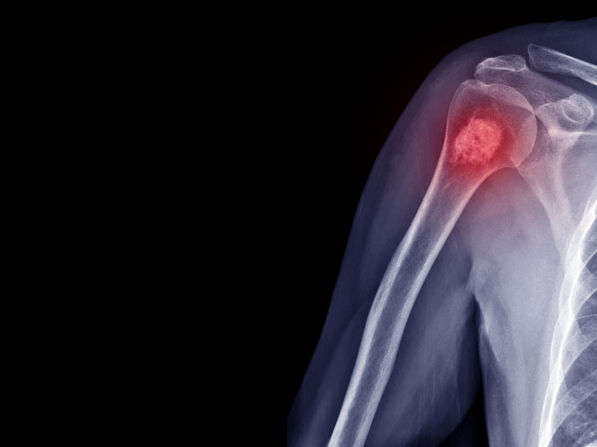 Radiografia di un encondroma