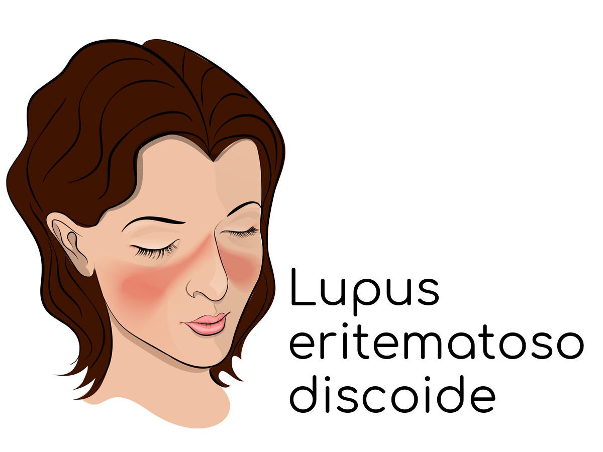 Disegno di un volto di donna affetta dal tipico eritema a farfalla del lupus discoide