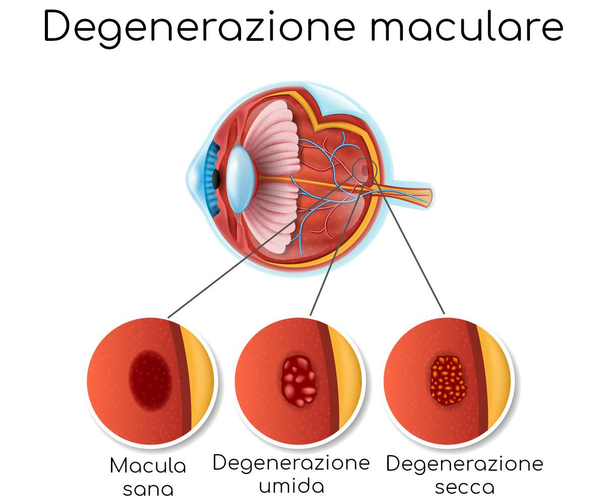 Grafica semplificata della degenerazione maculare senile