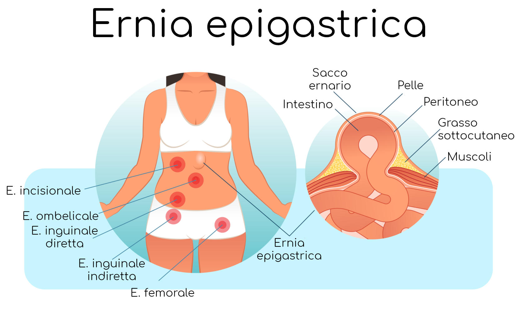 Infografica semplificata dell'ernia epigastrica