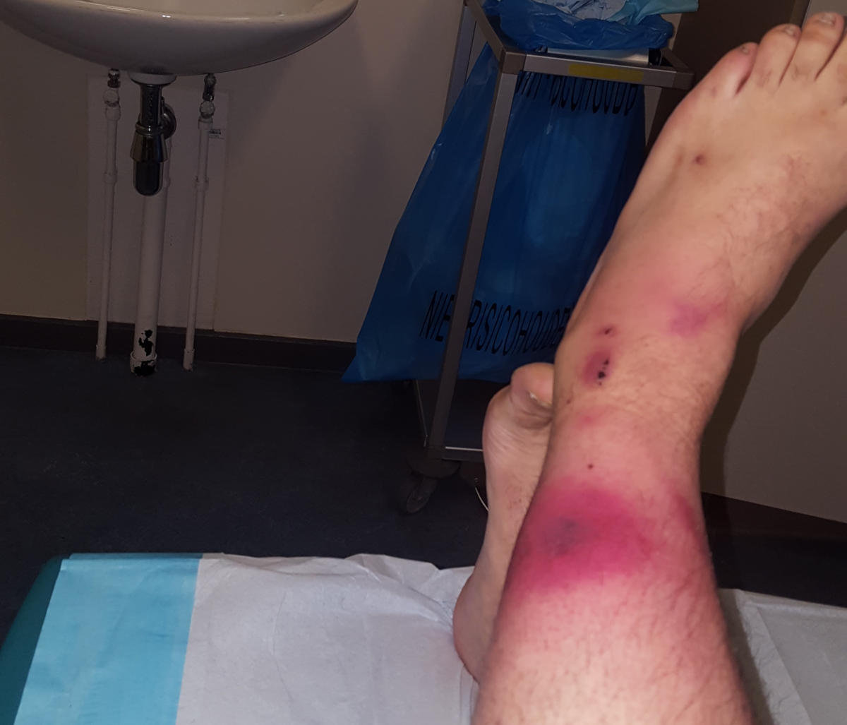 Primo stadio della fascite necrotizzante su una gamba