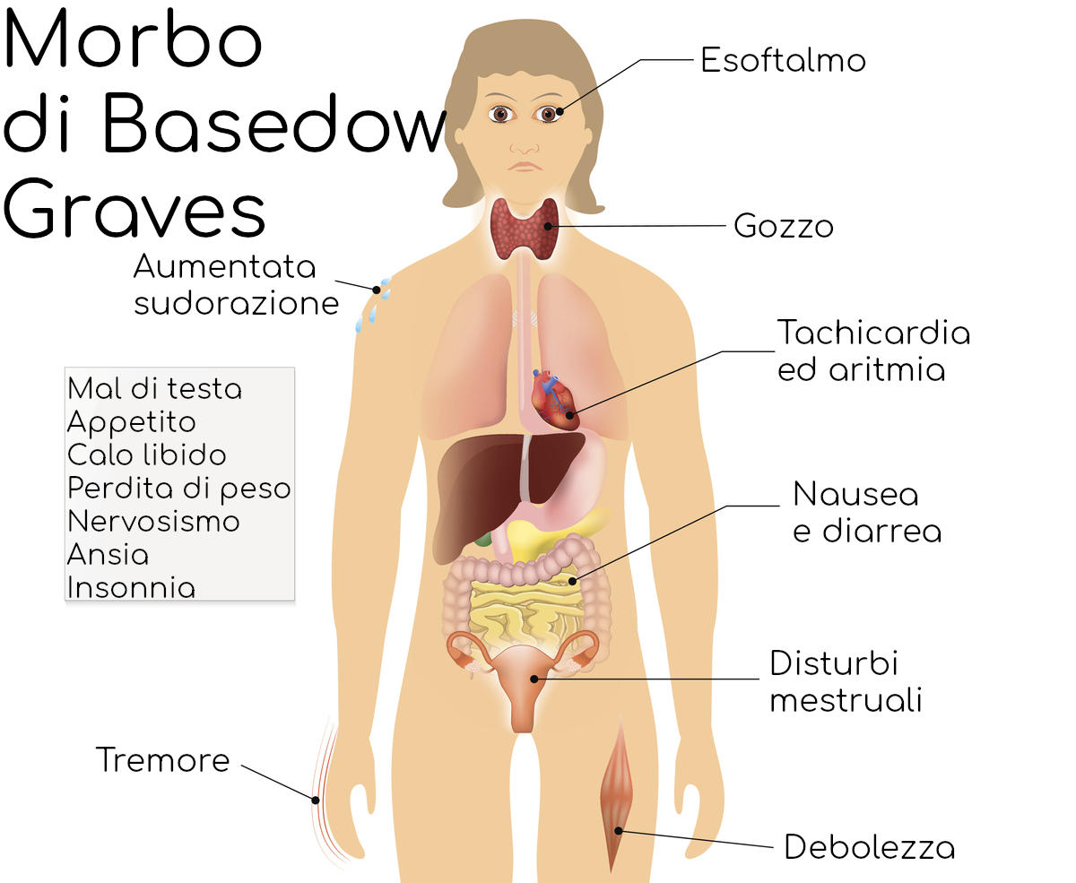 I sintomi del morbo di Basedow-Graves