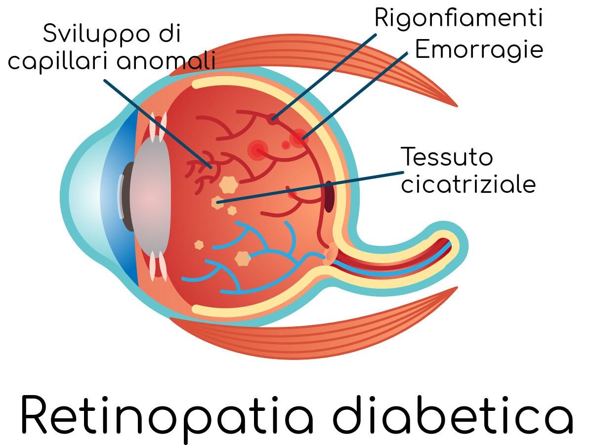 Semplificazione dei meccanismi di danno vascolare della retinopatia diabetica