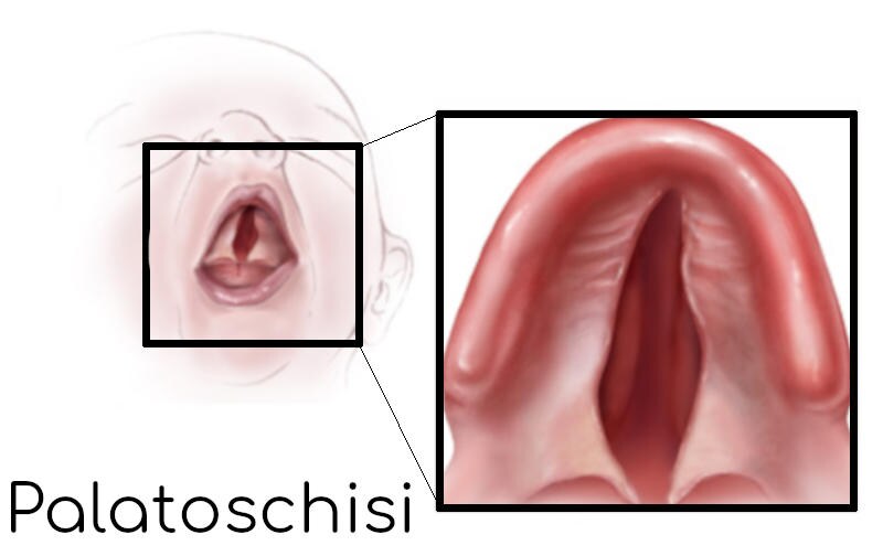 Palatoschisi