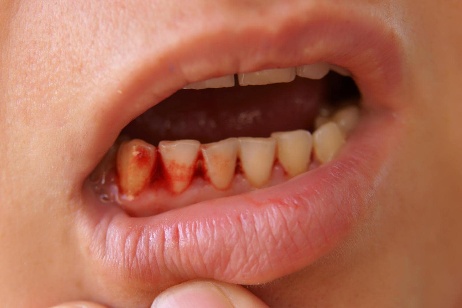Sangue in bocca