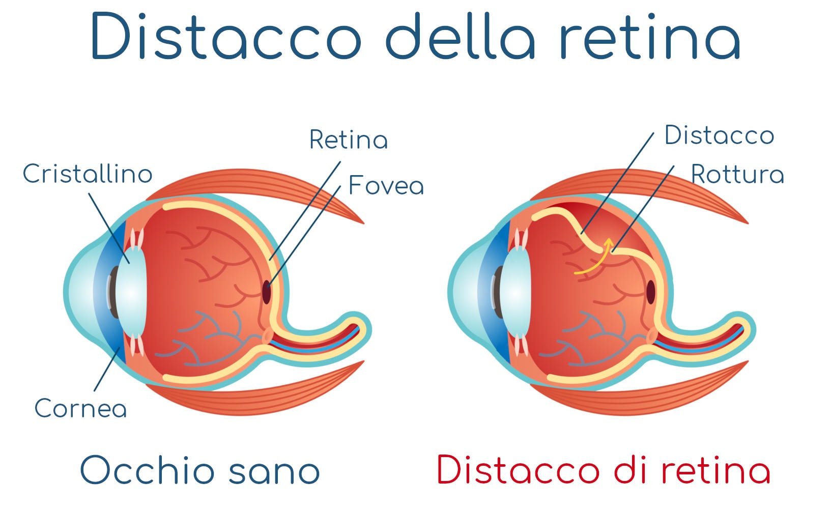 Infografica semplificata del distacco di retina