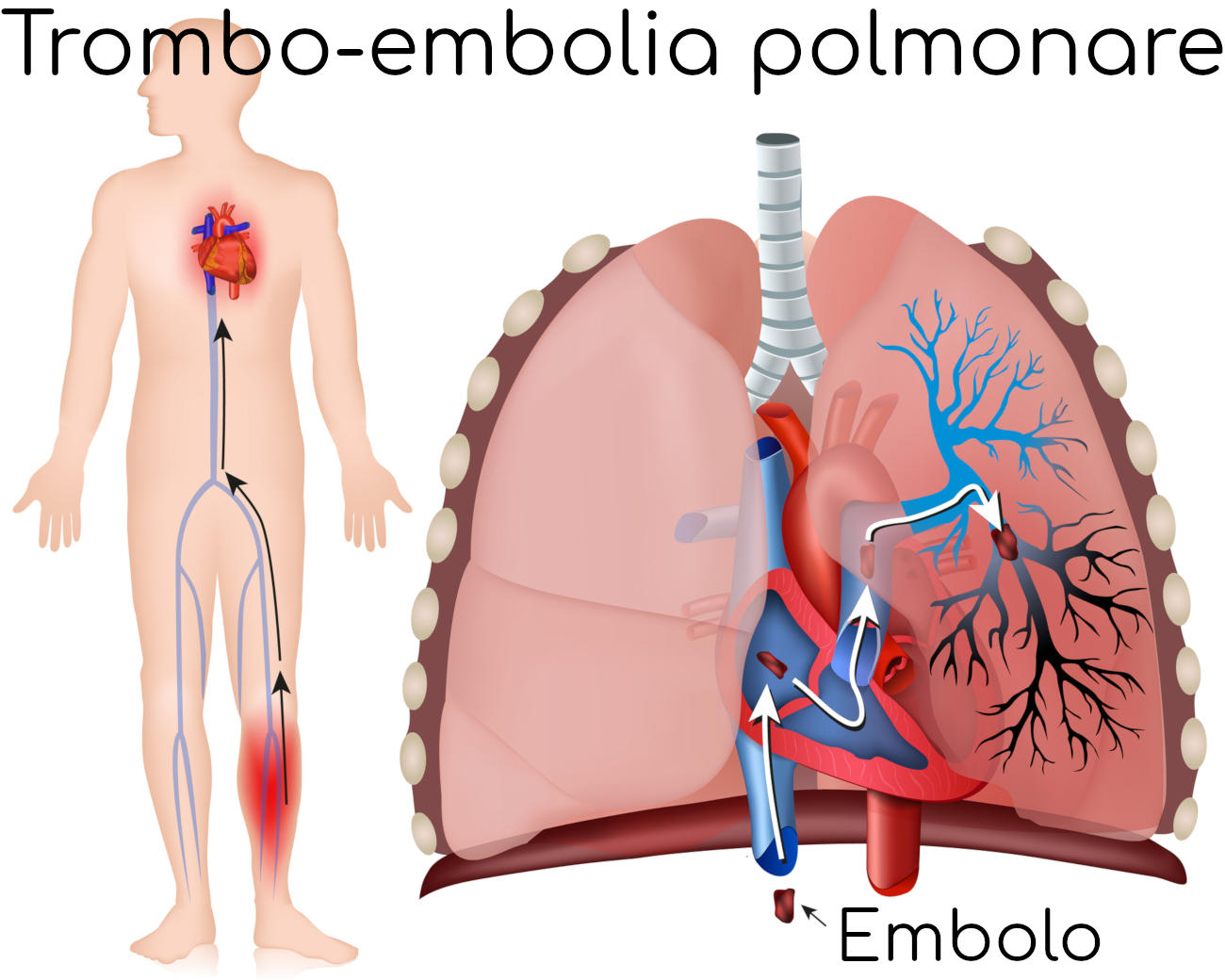 Tromboembolismo venoso