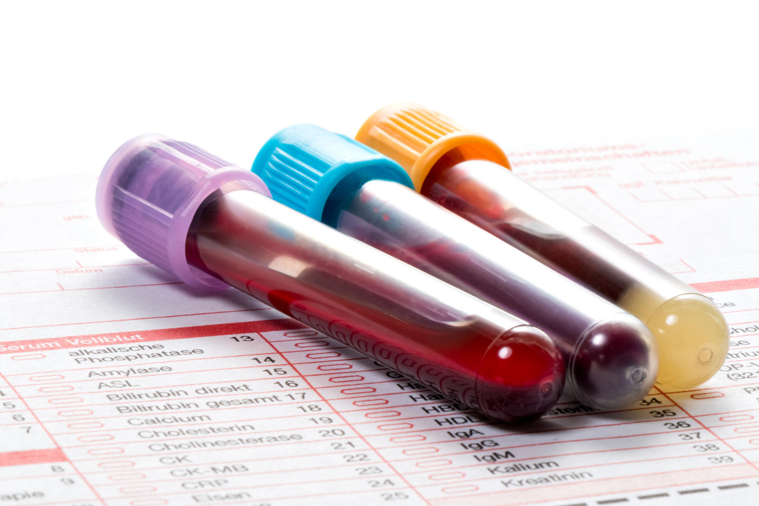 Tre provette piene di sangue appoggiate su una richiesta d'esame