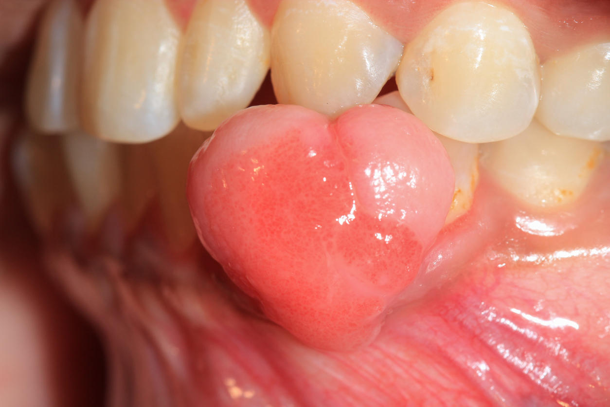 Granuloma piogenico sulle gengive