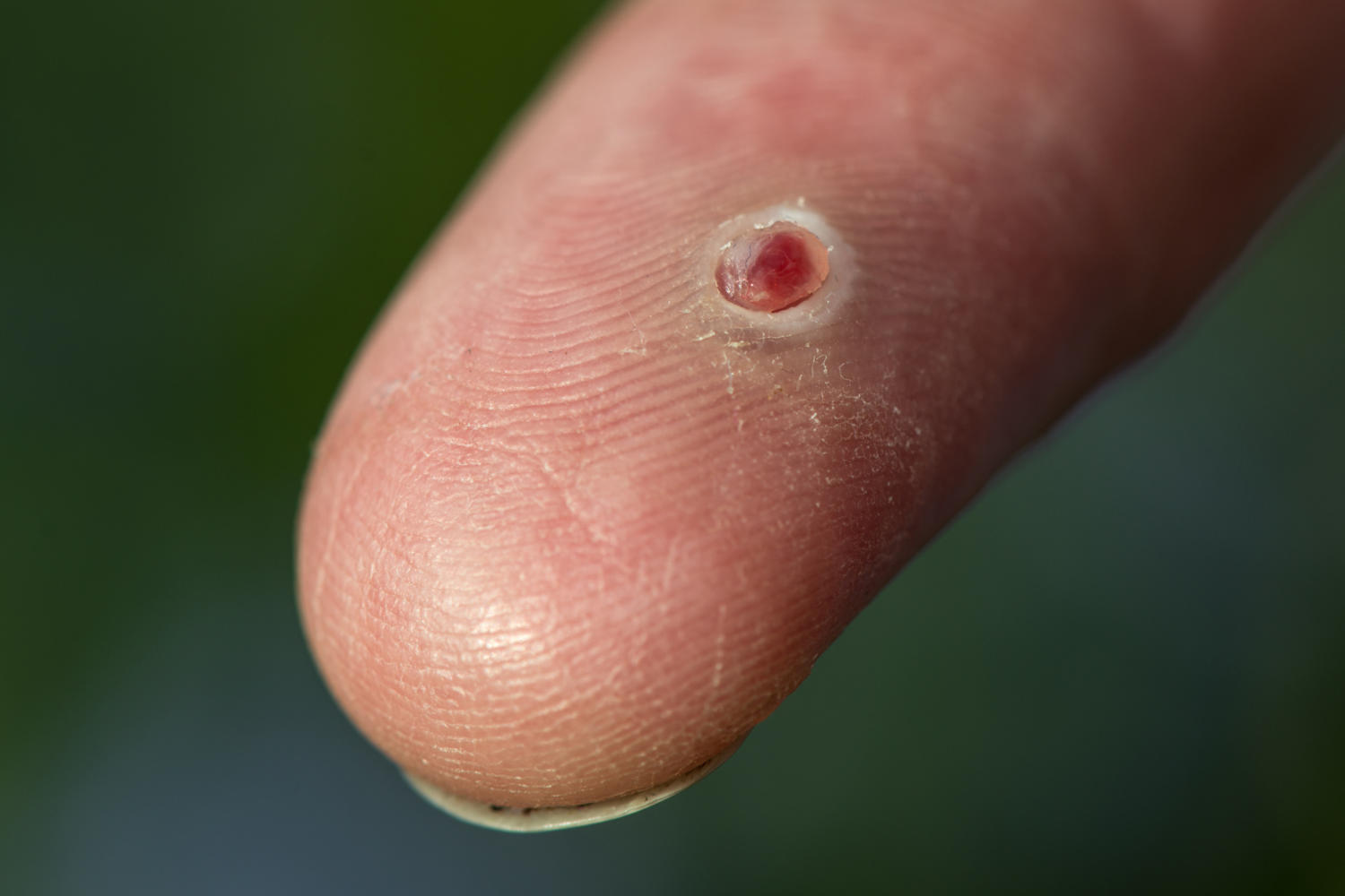 Granuloma piogenico su un dito