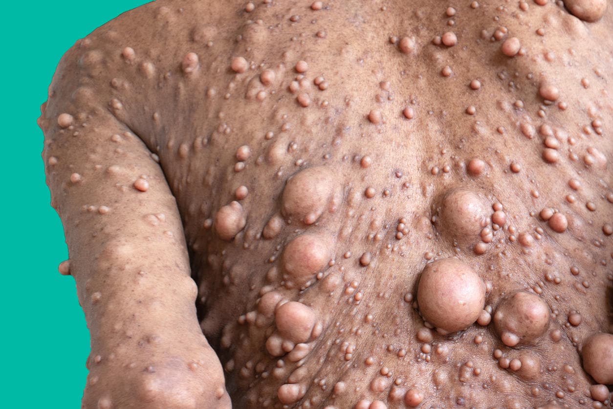 Lesioni sulla schiena in paziente affetto da neurofibromatosi di tipo 1