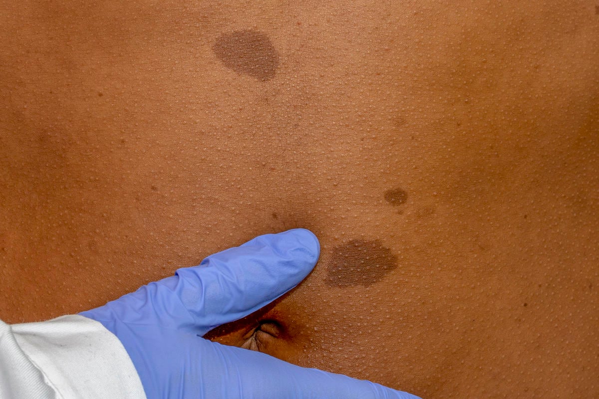 Macchie caffelatte tipiche della neurofibromatosi