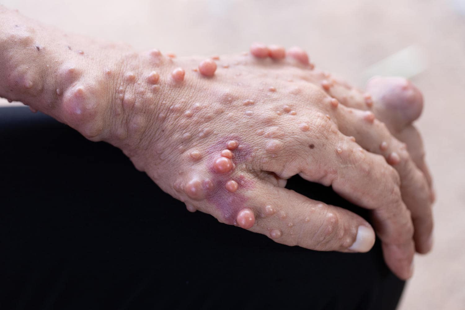 Caratteristici tumori della pelle della neurofibromatosi