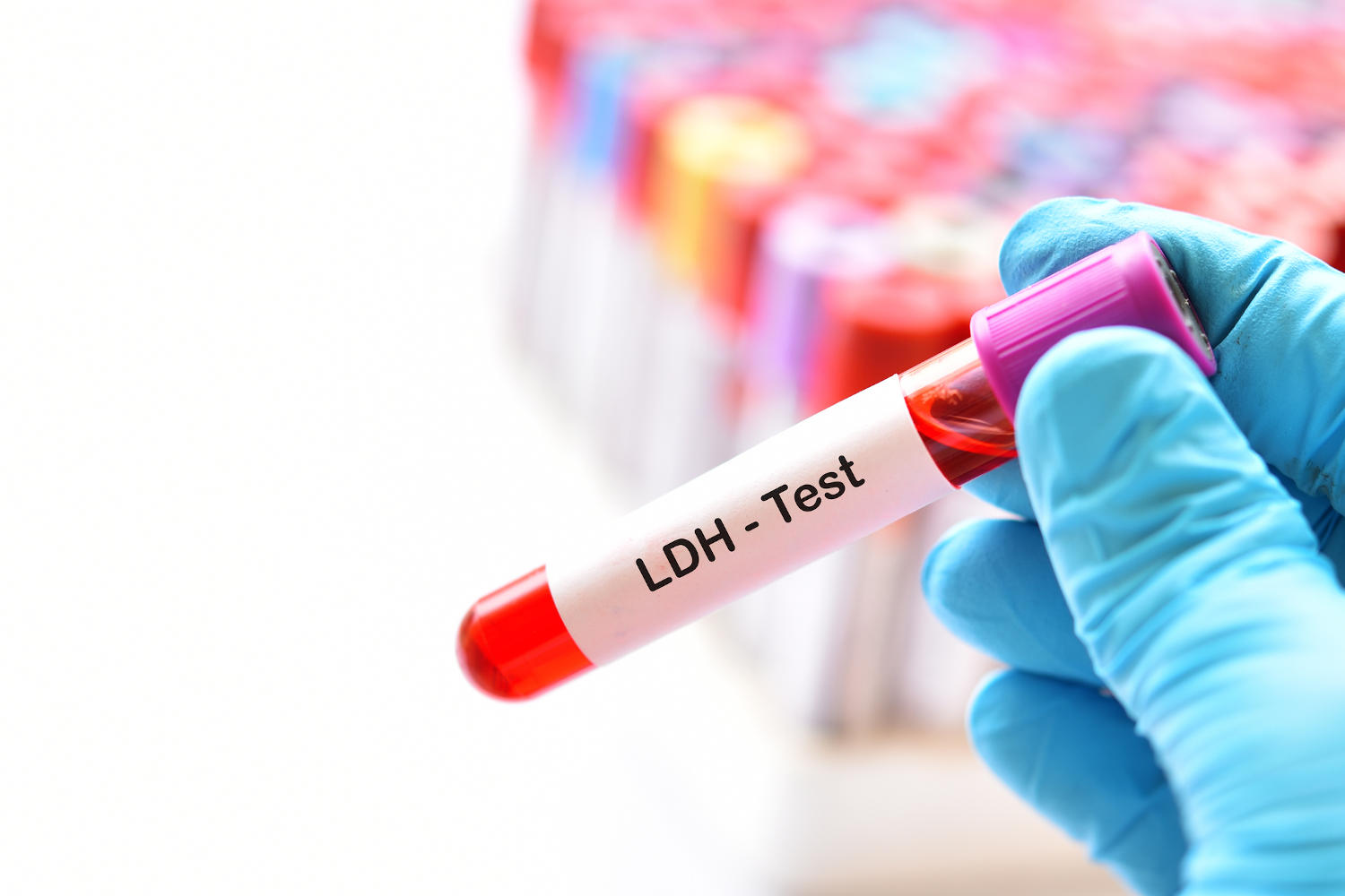 Provetta di sangue con la scritta LDH