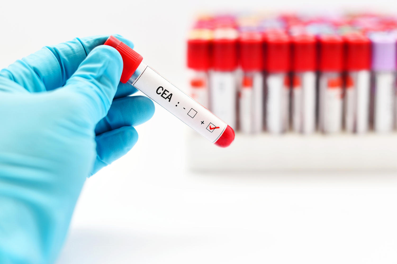 Provetta di sangue con la scritta CEA
