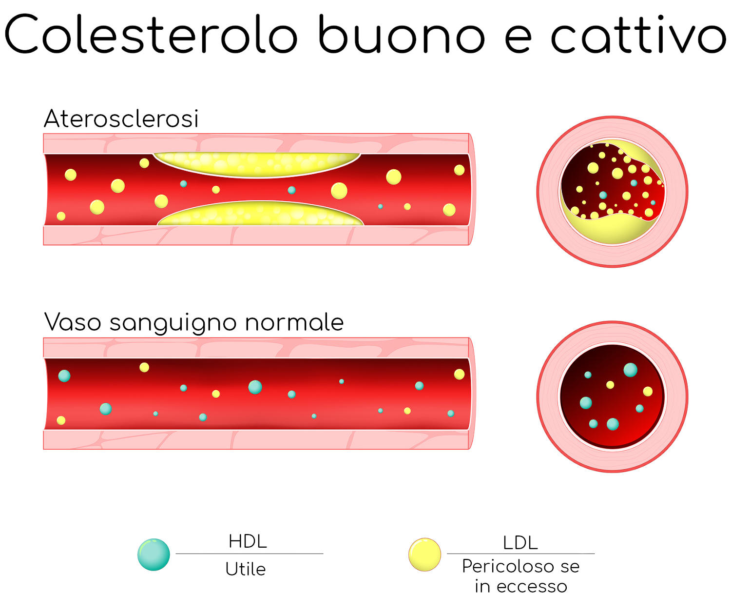Differenza tra vaso sanguigno affetto da aterosclerosi e vaso pervio