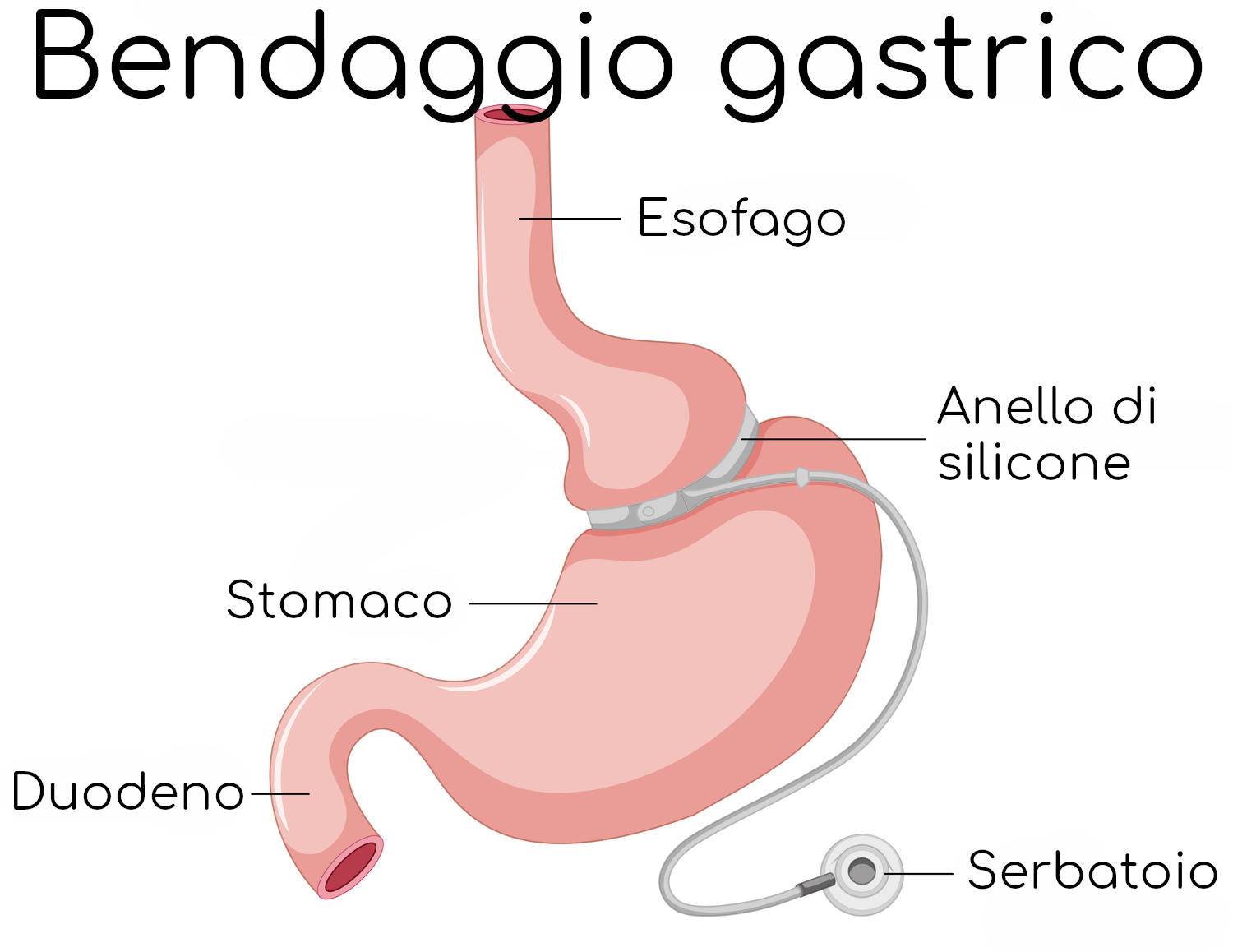 Procedura chirurgica di bendaggio gastrico