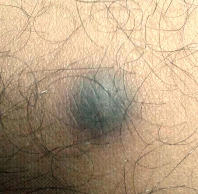 Fotografia di dermatofibroma