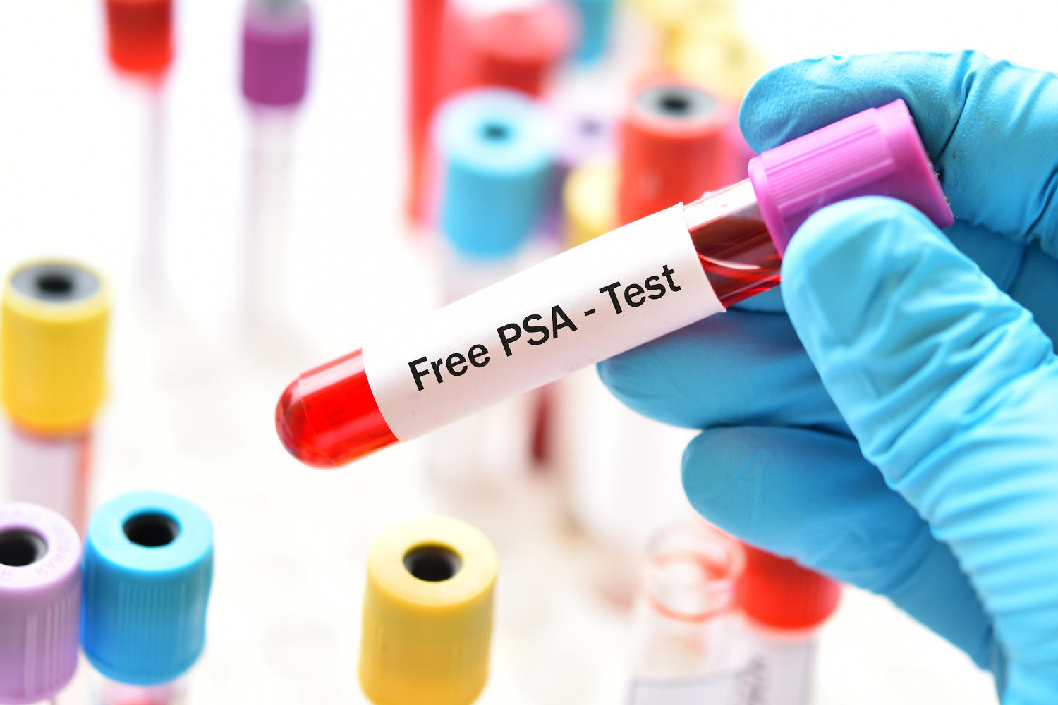 Provetta con la scritta Free PSA - Test