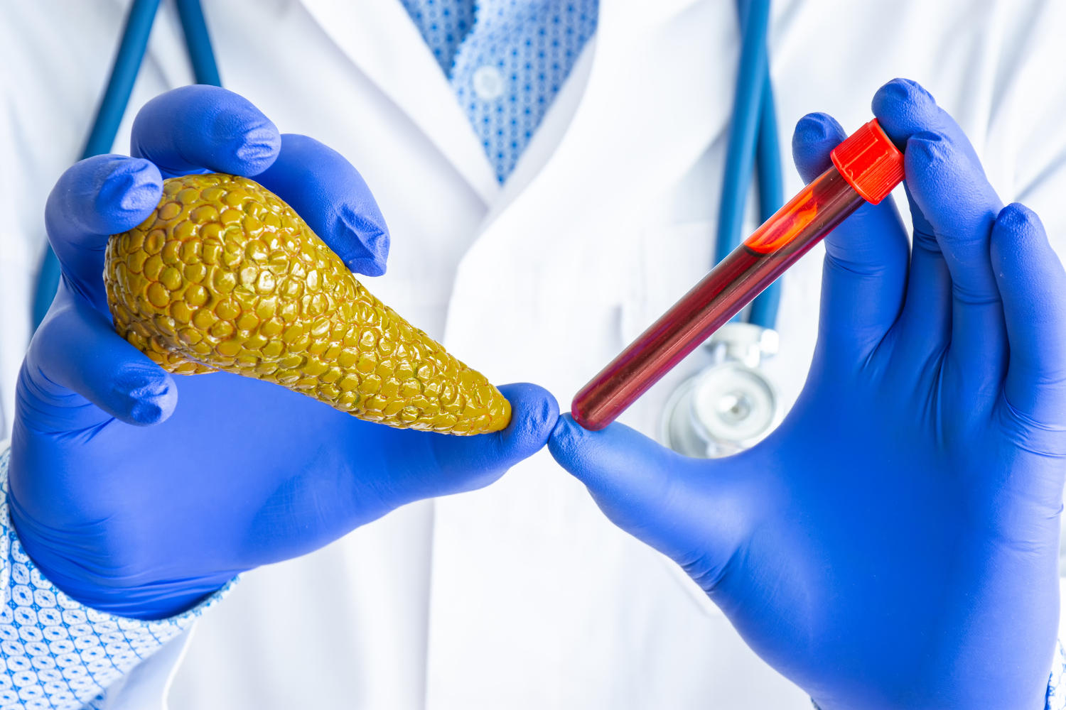 Medico che tiene in mano una provetta di sangue e il modello di un pancreas