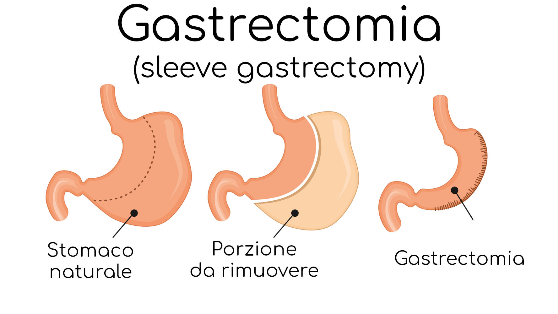 Gastrectomia