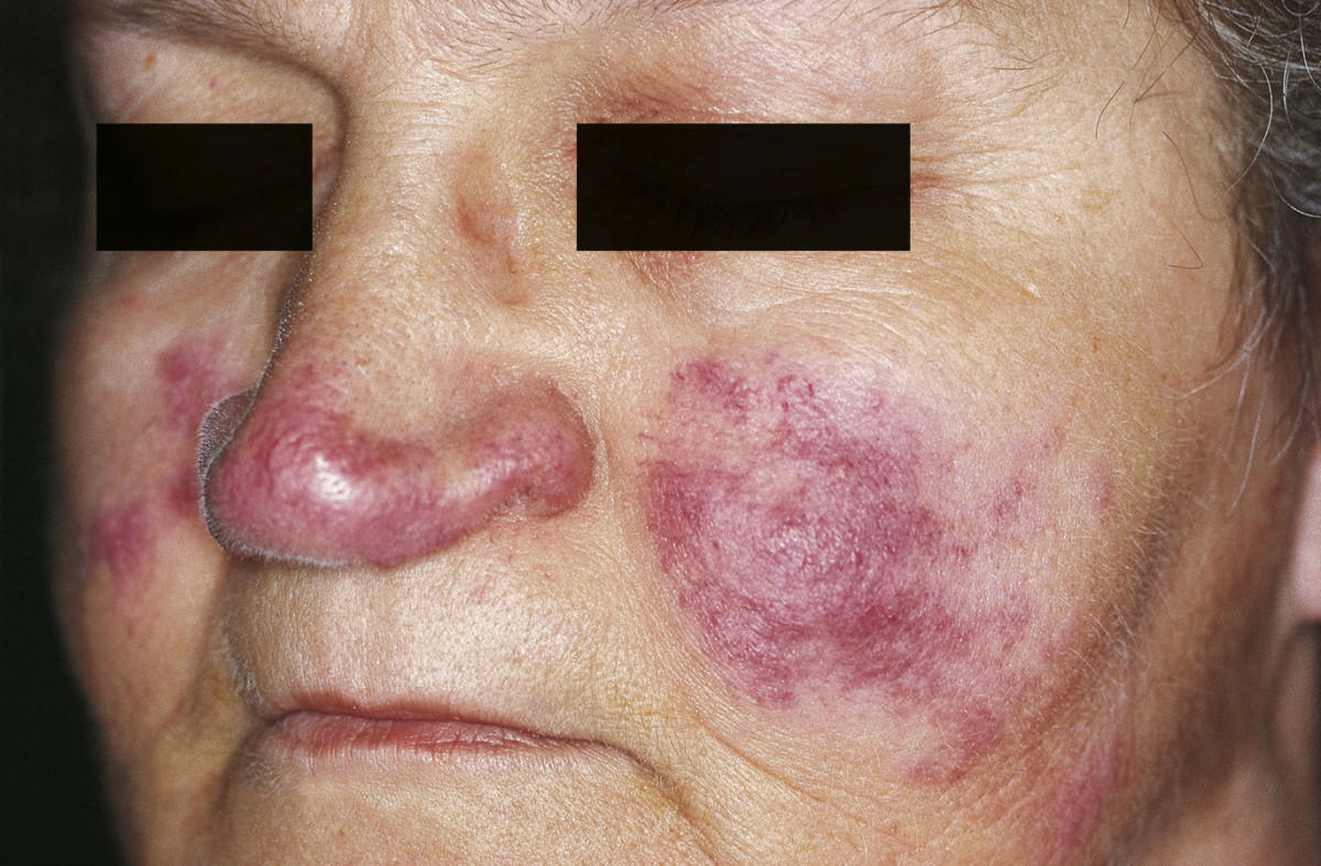Lupus Pernio sul viso di una donna