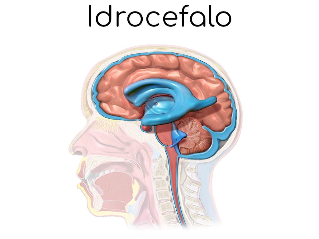 Anatomia semplificata dell'idrocefalo