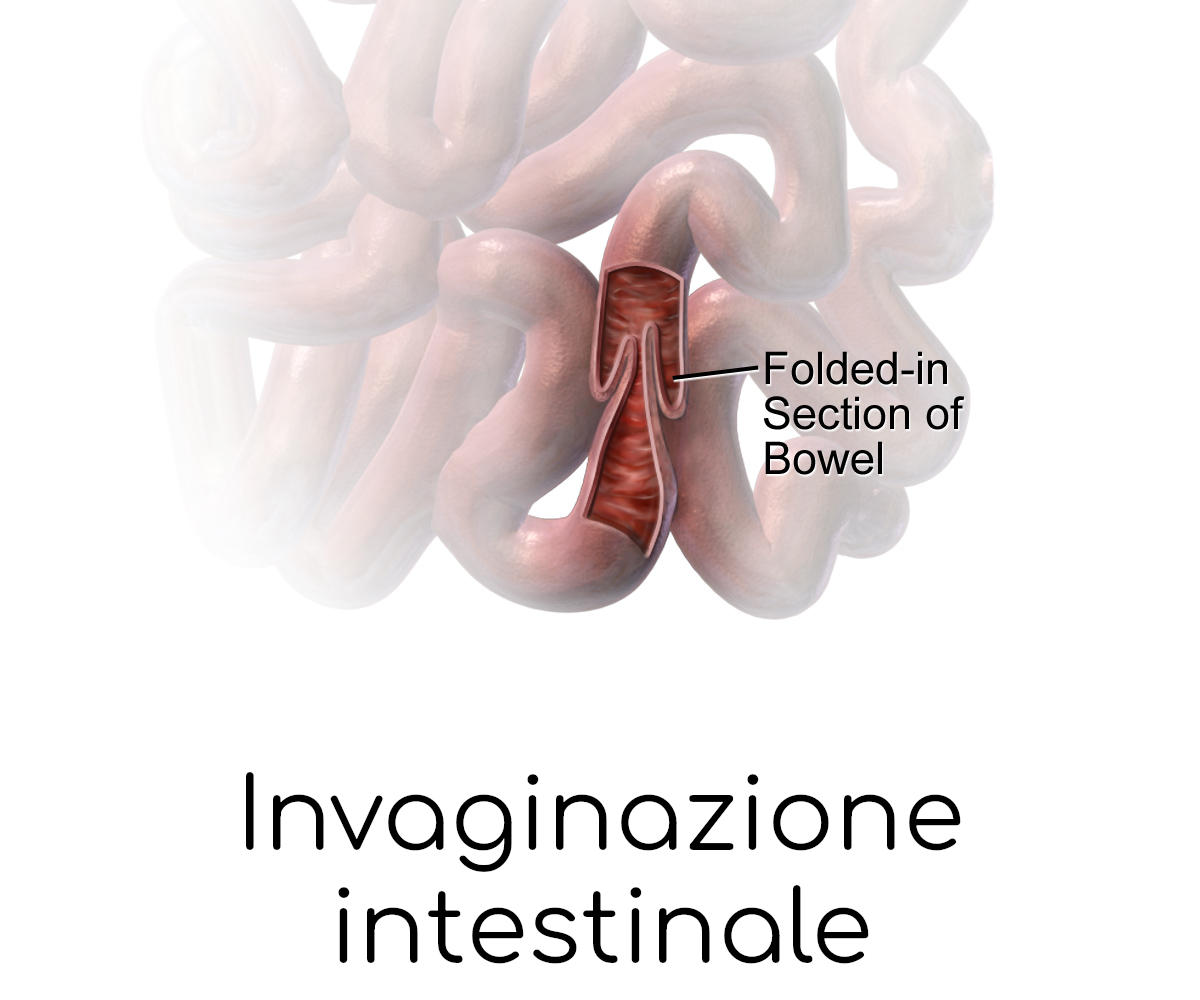 Modello 3D di invaginazione intestinale