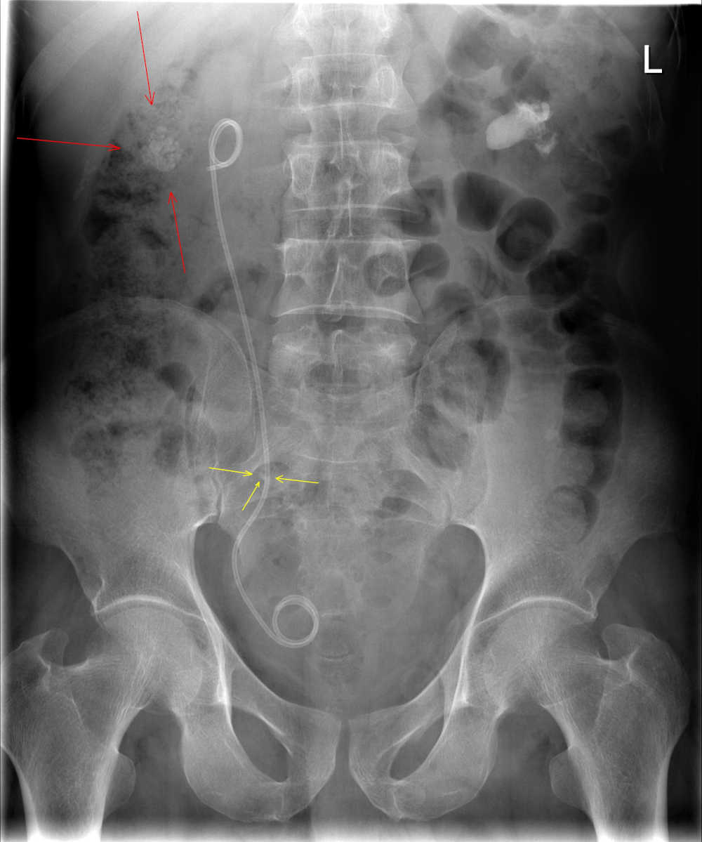 Radiografia di uno stent uretrale