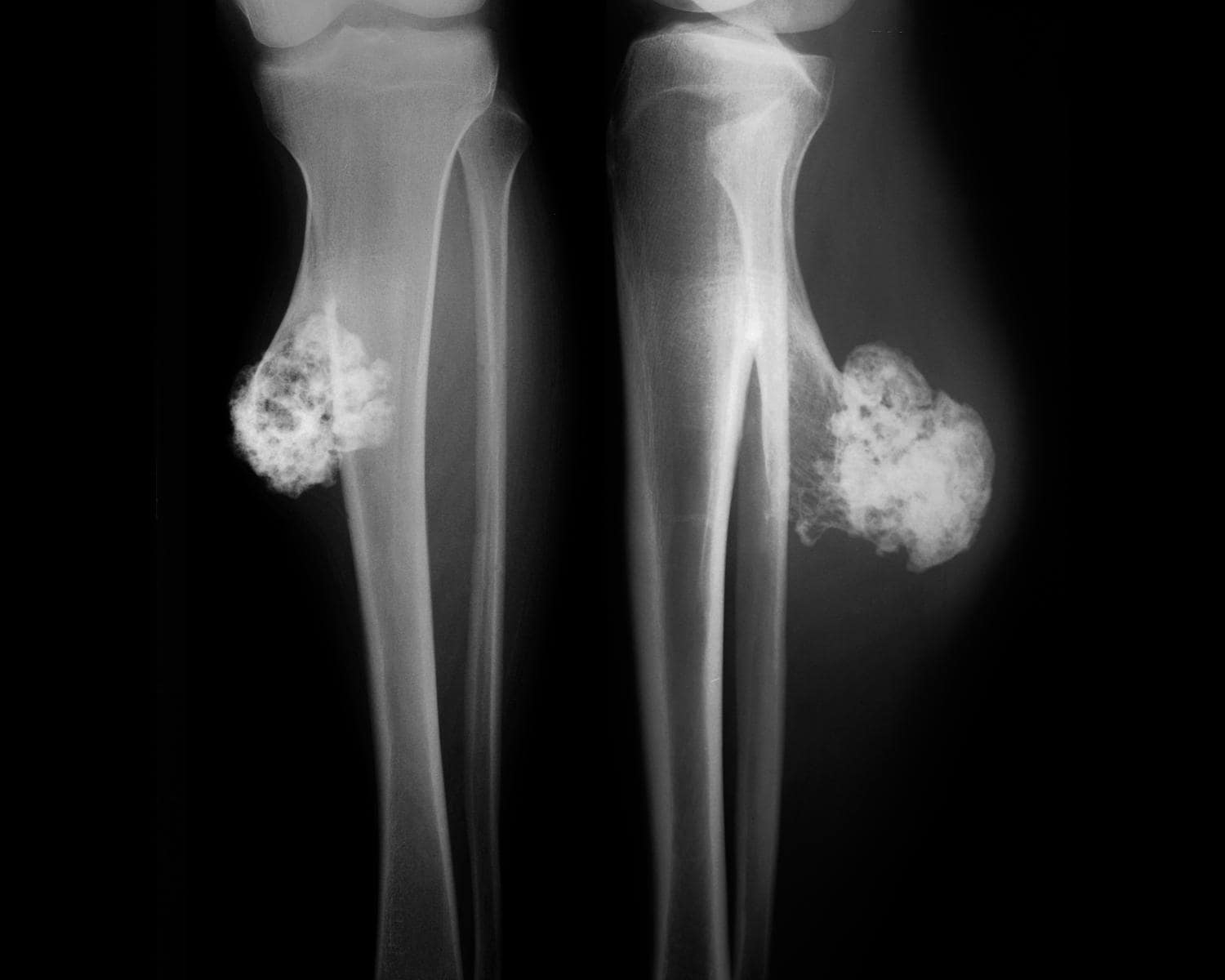Radiografia di un osteocondroma