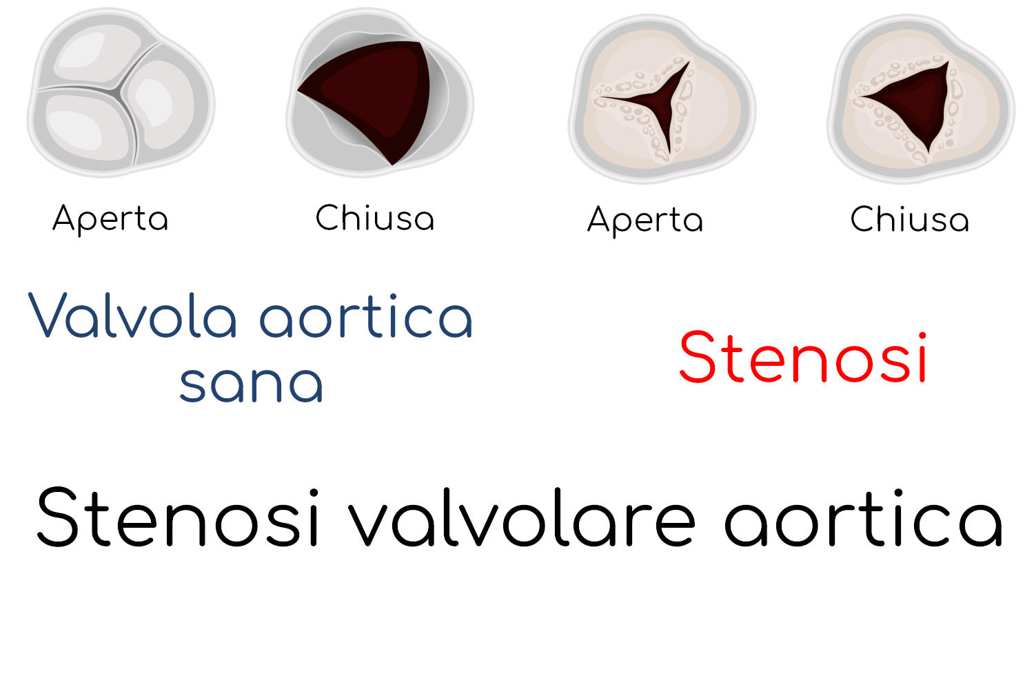Stenosi valvolare aortica