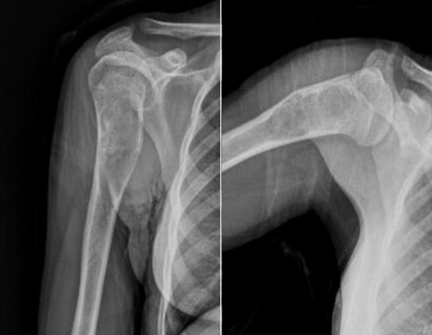 Radiografia di una cisti ossea