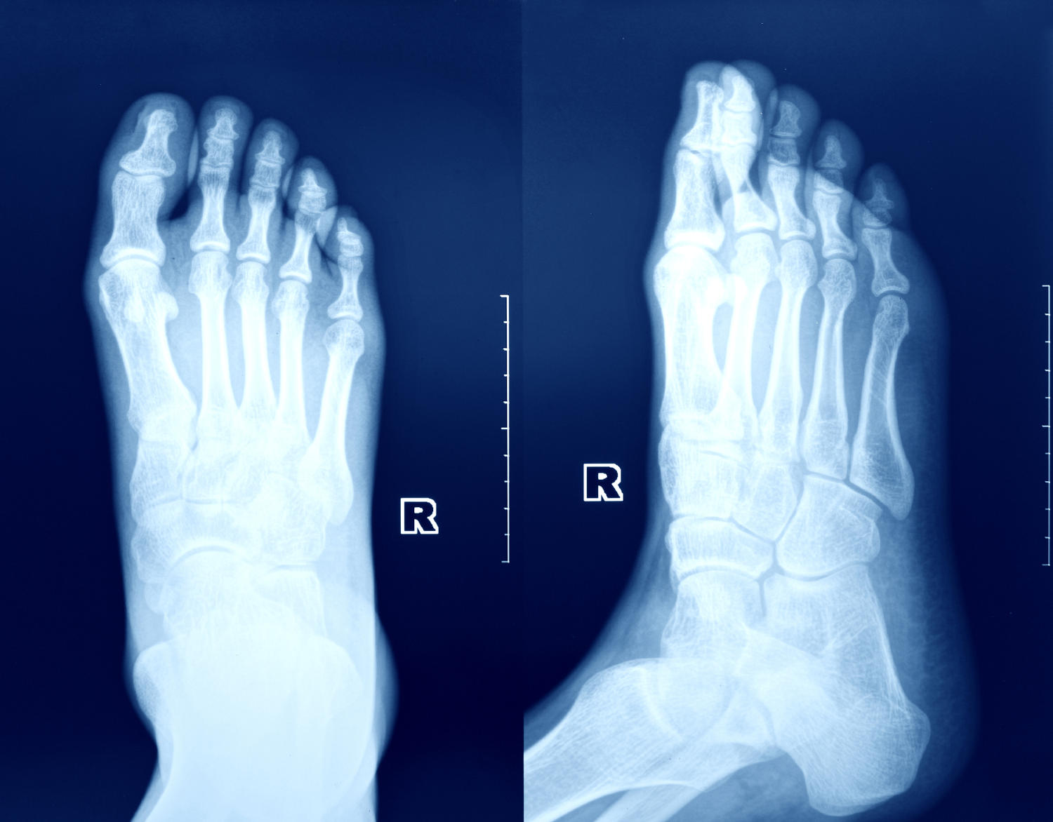 Radiografia di un piede