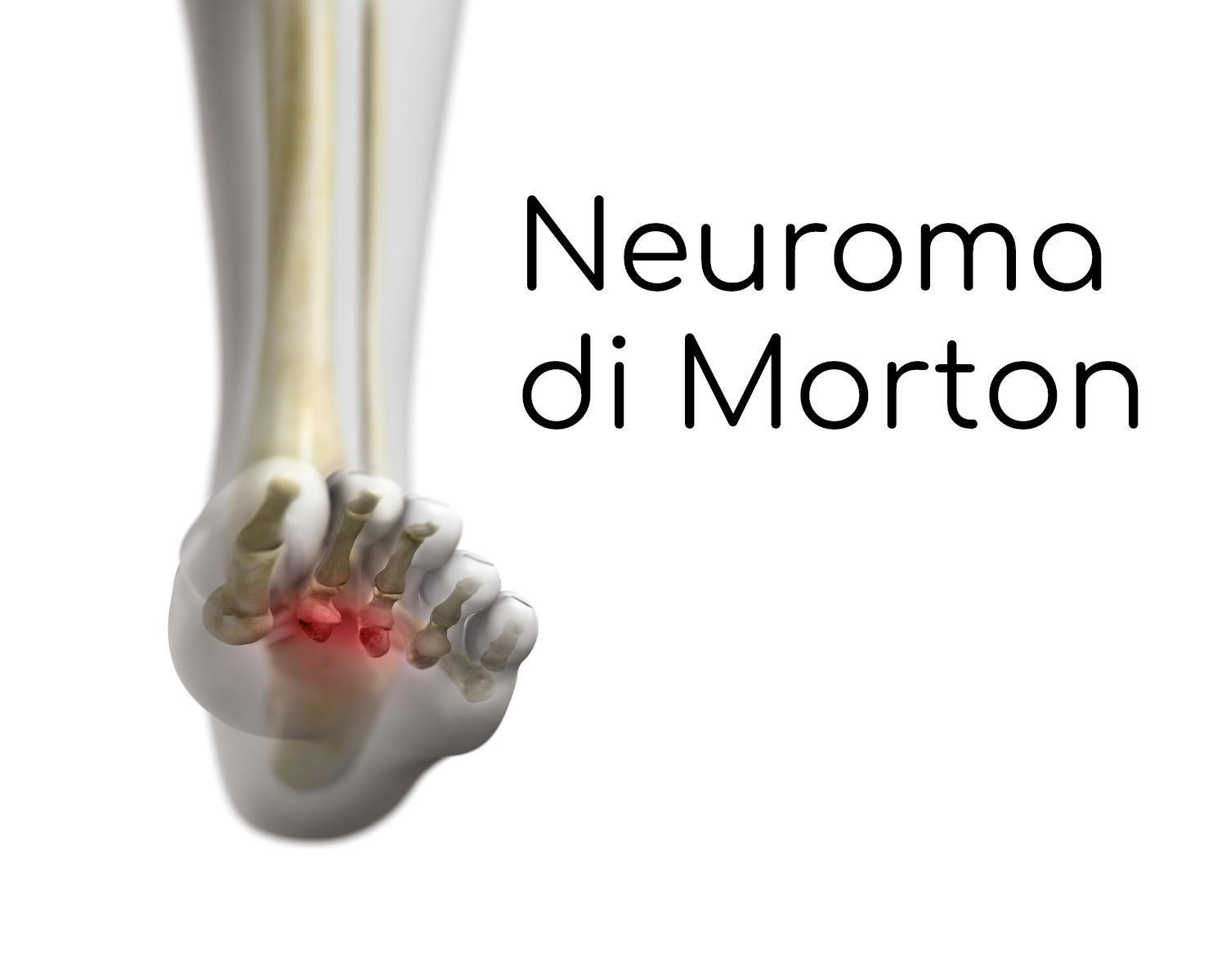 Neuroma di Morton