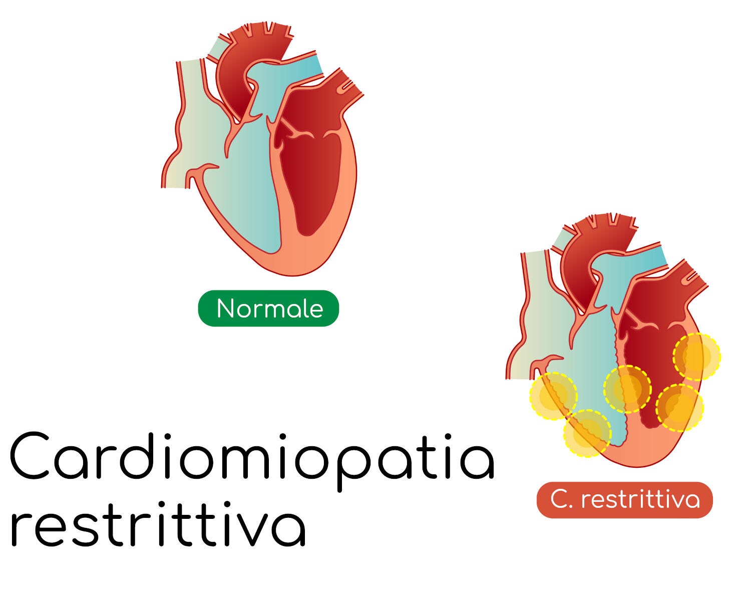 Cardiomiopatia restrittiva