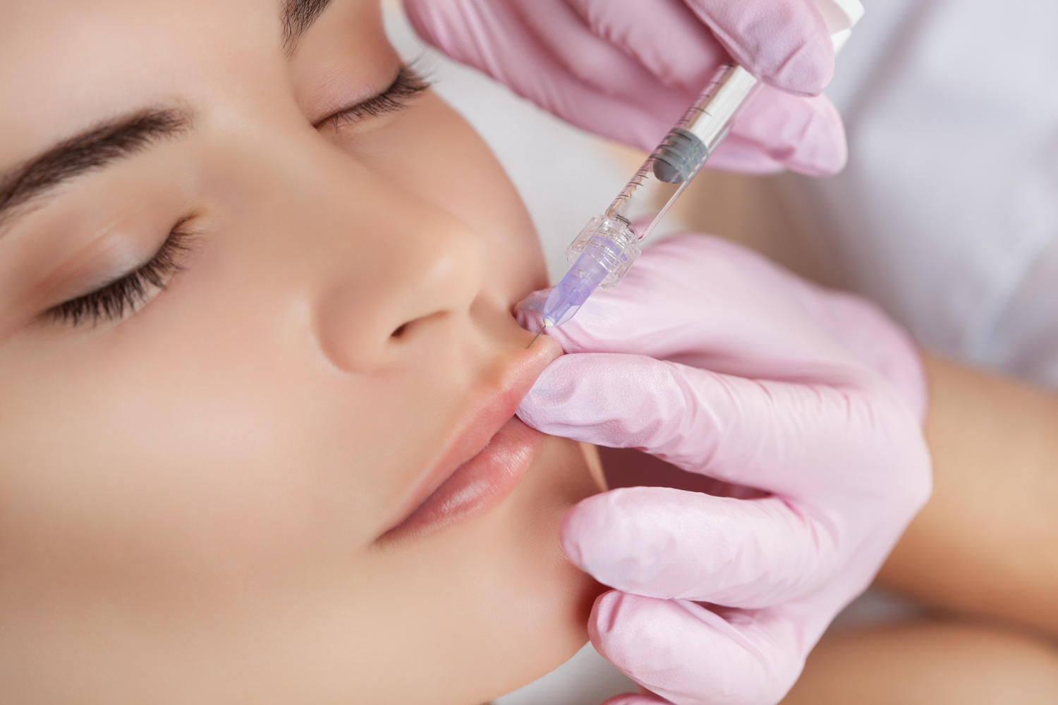 Filler acido ialuronico iniettato nel labbro