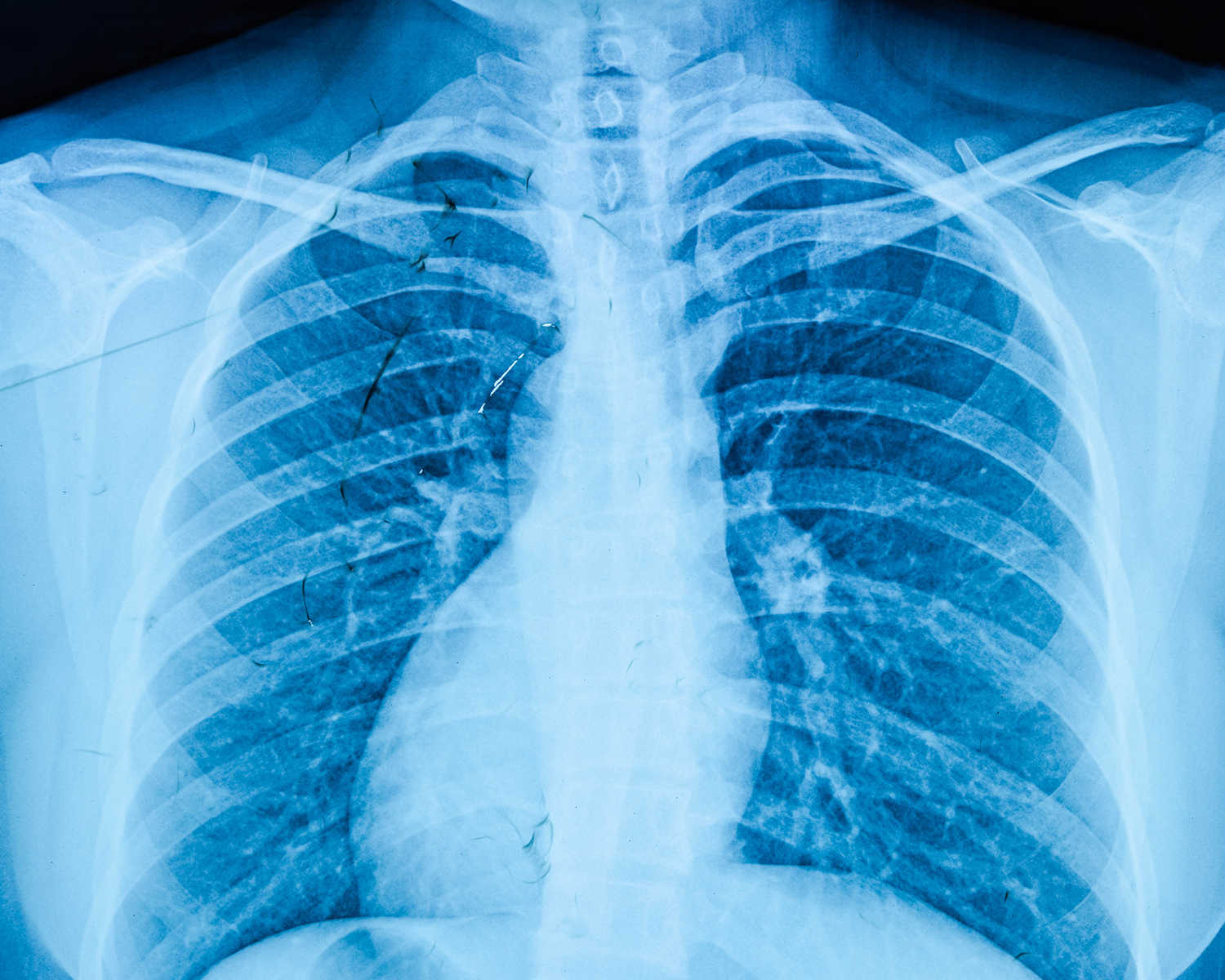 Radiografia ai polmoni